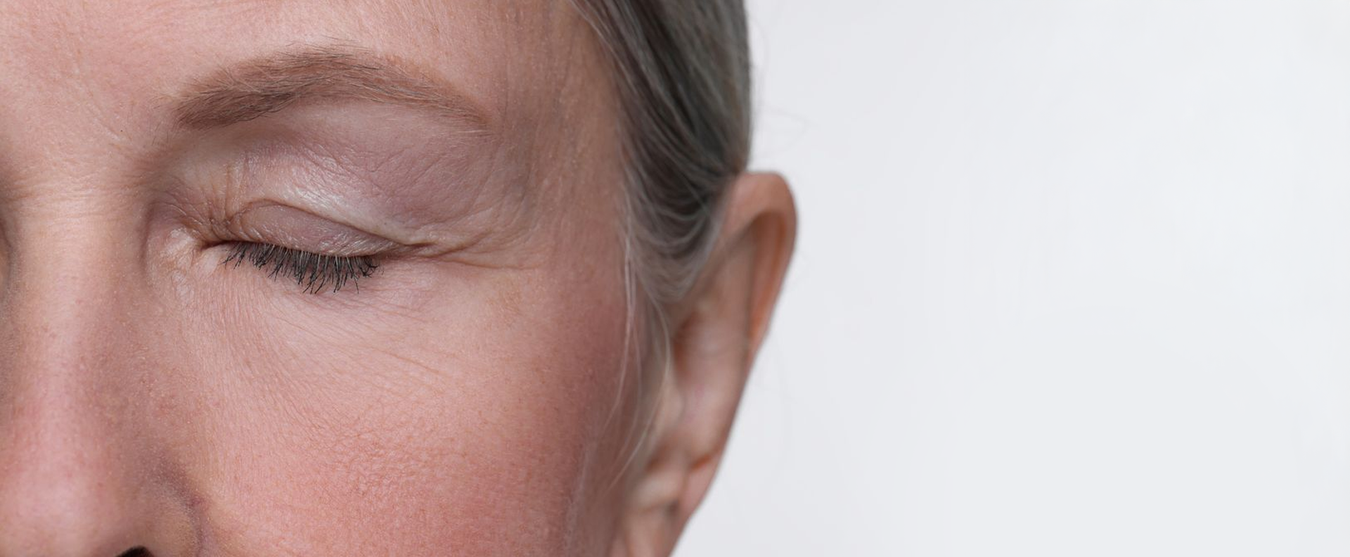 Blefaroplastia