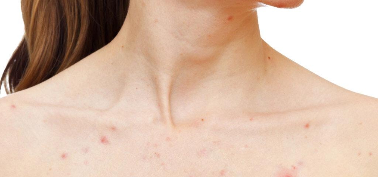 Acne Inversa MeDioStar